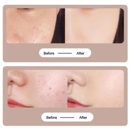 στυλό-λέιζερ-αφαίρεσης-ελιών-και-θεραπεία-του-δέρματος-κατά-της-ακμής-nevus-pen